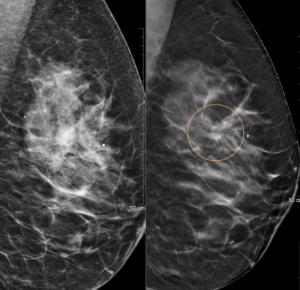 Aufnahmen einer 2D Mammografie und einer 3D Tomosynthese im Vergleich